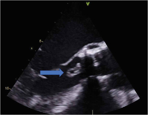 Figure 1. A transesophageal echocardiogram showing a large echogenic mass (blue arrow) measuring 14 mm x 7 mm on ventricular aspect in outflow tract.