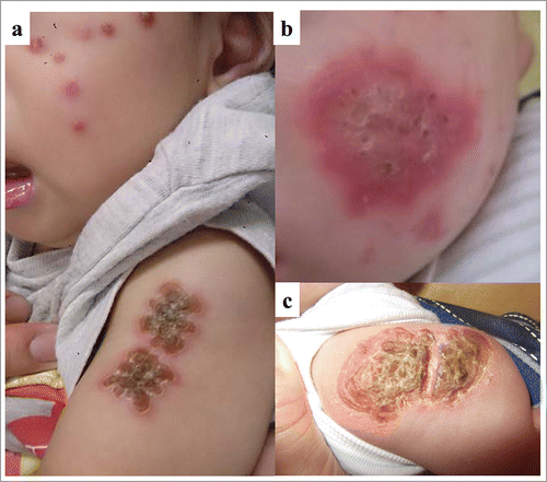Figure 1. Rash of cheek and BCG inoculation site on day 43 in patient 1 (a), and cheek (b) and BCG inoculation site (c) on day 23 of KD onset in patient 2.