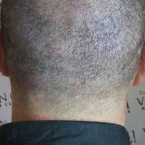 Figure 6 Post-scalp micropigmentation of the patient’s old strip harvest scar. Note: This photo is reproduced courtesy of Vinci Hair Clinic.