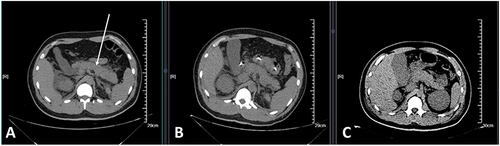 Figure 4 Abdominal computed tomography scans on day 1 (A), day 3 (B), and day 11 (C). (A) acute pancreatitis with peripancreatic fluid accumulation. (B) a marked increase in peripancreatic fluid accumulation and exudation, (C) pancreatic and peripancreatic changes are markedly improved.