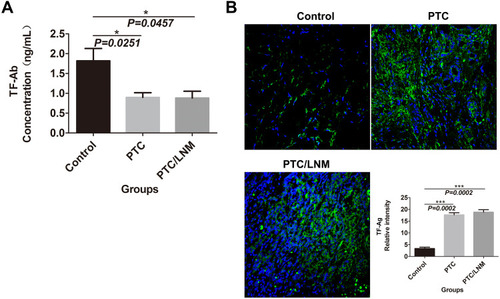 Figure 1 TF-Ab IgM expression differed between primary TC patients and healthy individuals; TC and adjacent tissues showed a diverse presentation of TF-Ag.Notes: (A) TF-Ab IgM levels were detected by ELISAs; the standard antigen was replaced by aGP, while the standard antibody was replaced by mAb A78-G/A7. The serum of TC patients and normal subjects was analyzed. The expression levels were quantified by reading the absorbance value (OD value) at 450 nm on a microplate reader. The horizontal coordinate represents the grouping, respectively are Control: healthy people; PTC: papillary thyroid carcinoma patients without lymph node metastasis; PTC/LNM: papillary thyroid carcinoma patients with lymph node metastasis. The ordinate represents the expression quantity of TF-Ab. Data=means±SEM. Compared with the Control group, *P<0.05. (B) The expression of TF-Ag in TC and normal tissues was detected by immunofluorescence. The horizontal coordinate represents the grouping, respectively are Control: normal paracancer control tissue; PTC: papillary thyroid carcinoma tissue without lymph node metastasis; PTC/LNM: papillary thyroid carcinoma tissue with lymph node metastasis. The ordinate represents the expression quantity of TF-Ag. Data=means±SEM. Compared with the Control group, ***P<0.001.Abbreviations: TF-Ab, Thomsen–Friedenreich antibody; TC, thyroid cancer; TF-Ag, Thomsen–Friedenreich antigen; ELISAs, enzyme-linked immunosorbent assay; aGP, asialoglycophorin from human blood group MN; mAb A78-G/A7, Thomsen–Friedenreich monoclonal antibody (A78-G/A7).