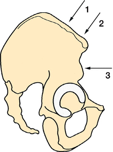 Figure 3. Pin positions (lateral view). The 2 most cranial pins are inserted on top of the pelvic rim, 3 cm and 1 cm posterior to the anterior superior iliac spine (referred to as position 1,2). The ventral pin is inserted 1 cm cranial to the anterior inferior iliac spine (position 3), in combination with pin 1 (referred to as pin position 1,3) and in combination with pin 2 (referred to as pin position 2,3). Insertion depths of 50 mm in predrilled holes in the perspex hip bone were standard. The distance from pelvis to clamp on the fixator pins was also standard. This distance was 3 cm in the cranial position, and 6 cm in the ventral pin position.