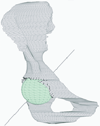 Figure 3. Acetabular cup characteristics. A least-squares sphere is fitted in the acetabulum. From this object, the hip joint center and diameter are assessed. The acetabulum orientation is defined as the plane normal from a least-squares plane through the acetabular rim points. The latter are visualized as black dots. [Color version available online.]