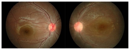 Figure 1 Left fundus (right photo) showed pigmentary changes of the retina with attenuated vessels and mild optic disk edema. Right fundus (left photo) was normal.