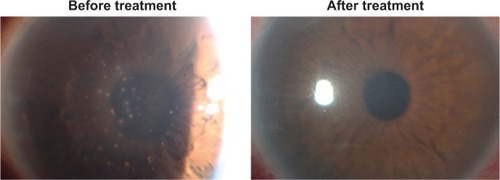 Figure 1 Slit-lamp microscopic photograph with cytomegalovirus anterior uveitis in Patient 1 showing numerous mutton fat keratic precipitations on the central to inferior corneal endothelium with mild stromal edema and elevation of intraocular pressure.