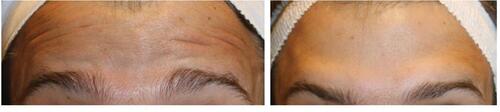 Figure 6 Feminization of the eyebrow using onabotulinumtoxinA in a patient in his late 20s. The patient before (left) and 2 weeks after (right) treatment. Patient images provided by Terrence Keaney, MD.