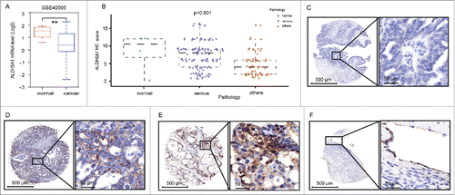 Figure 1. ALDH5A1 was downregulated in patients with ovarian tumor. (A) Comparison of ALDH5A1 expression in microdissected tumor epithelial tissues with that of microdissected normal epithelial tissues using the GSE40595 database. (B) Immunohistochemical analysis of ALDH5A1 expression in ovarian tissues. IHC score of each patient was plotted as an individual dot in the chart. (C) Ovarian tumor samples weakly positively stained with a staining index marked as +. (D) Ovarian tumor samples moderately positively stained with a staining index marked as ++. (E) Ovarian tumor samples strongly positively stained with a staining index marked as +++. (F) Normal ovarian samples strongly positively stained with a staining index marked as +++. Others. Mucinous papillary adenocarcinoma(n = 24), adenocarcinoma (n = 7), Disgerminoma (n = 5), Endodermal sinus carcinoma(n = 7), Endometrioid carcinoma(n = 3), Embryonal carcinoma (n = 1), Immature teratoma(n = 2), Mature teratoma(n = 1), Clear cell carcinoma (n = 1), Transitional cell carcinoma(n = 1), Strumal carcinoid(n = 1), Squamous cell carcinoma from teratoma with malignant transformation(n = 3), Granular cell tumor(n = 4).