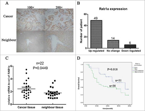 Figure 1. Rab1a was overexpressed in ICC and associated with poor prognosis (A) Shown the IHC results of Rab1a expression in CCA tissues, 100* and 200* mean the magnification (B) The patients number of different expression of Rab1a in ICC tissues were shown with a histogram (C) The result of mRNA level of Rab1a between cancer tissue and neighbor tissue were showed and statistically analyzed (D) Overall survival of 69 ICC patients were analyzed with Kaplan-meier method.