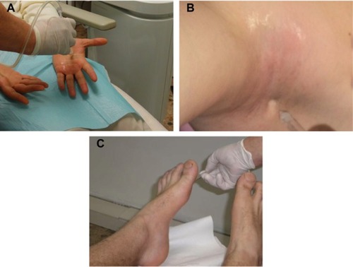 Figure 1 Treatment of primary palmar (A), axillary (B), and plantar (C) hyperhidrosis with lidocaine and botulinum toxin A delivered by JetPeel™-3.