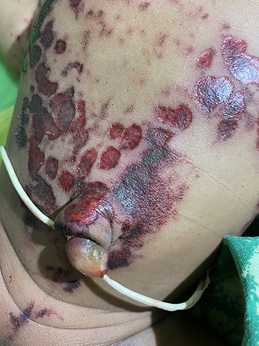Figure 2 The newborn, miraculously surviving being buried alive, exhibits scattered abrasions and bruises. Photographed in the emergency department post-cleaning to remove soil, with the umbilical cord already cut and securely ligated.