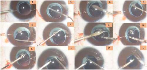 Figure 3. Initial step of opening the capsular bag (A-L).