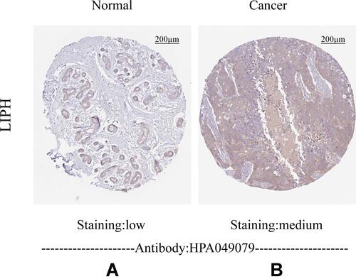 Figure 4 Immunohistochemistry staining of LIPH in the normal breast tissue (A) and breast cancer (B).