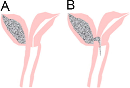Figure 4 Anatomical illustrations of the utero-cervical-vaginal anatomy in Type IV UGTOIRA syndrome (unilateral partial cervical aplasia). Complete bicorporeal uterus, double cervix with unilateral partial cervical aplasia, with one normal vagina, without communication (A), with partial cervical fusion and a fistula in the cervical fusion (B).