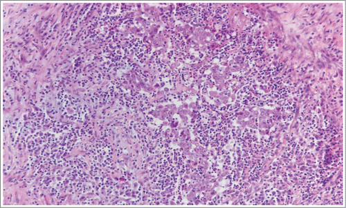 Figure 1. Pathological features of renal medullary carcinoma. Pathologic surgical specimen of left kidney, revealing highly atypical cells arranged in nests and sheets, with intratumoral neutrophilic infiltration and peritumoral inflammation and fibrosis.
