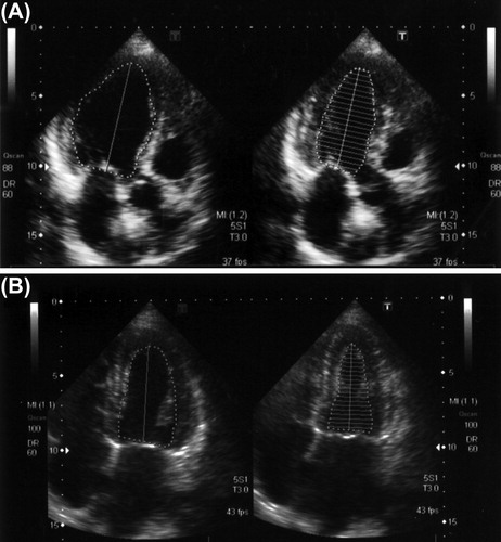 Figure 4. The B-mode echocardiogram. (A) The cardiac echogram on admission showed hypokinetic wall motion and anteroseptal hypokinesis. The ejection fraction determined by the modified Simpson’s method was 45.9%. (B) One year after the prescription of a β-blocker, the cardiac echogram showed normal wall motion of the anteroseptum. The ejection fraction determined by a modified Simpson’s method was 60.7%.