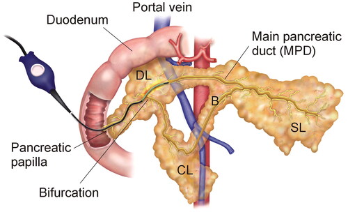 Figure 2. Animal model. Endoluminal thermal ablation of the main pancreatic duct (MPD) conducted using the ClosureFast® system (Medtronic, Mansfield, MA, USA). SL: splenic lobe; DL: duodenal lobe; CL: connecting lobe (CL); B: Bridge. Note that the connecting lobe and bridge are present in the pig anatomy but not in the human pancreas.