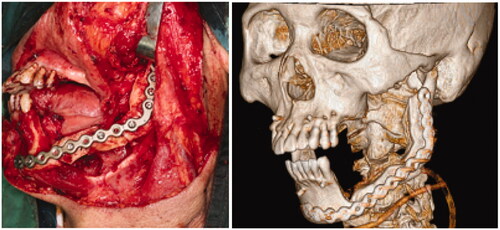 Figure 10. Representative images of another case. The picture on the left shows the intra-operative clinical photos while the picture on right shows the post-operative CT Scan.