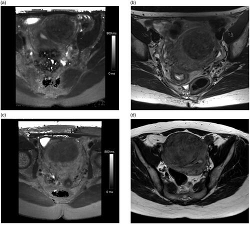 Figure 5. Example pretreatment axial T2 relaxation time maps and corresponding screening MRI axial T2-weighted images illustrating SSI classification: (a) T2 I: T2 value of 63 ms, (b) SSI II, (c) T2 II: T2 value of 89 ms, and (d) SSI II.