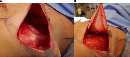 Figure 1 Inframammary skin-sparing mastectomy approach demonstrating suture of ADM to PM muscle prior to insertion of implant.