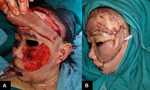 Figure 3 Wide excision and forehead flap. The skin flap was taken from the forehead (A). The skin graft was placed on the forehead to close defect (B).