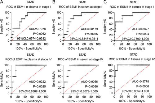 Figure 5 ESM1 might be a sensitive biomarker for the diagnosis of STAD. The ROC curves of ESM1 at stage I and II in (A) plasma, (B) serum, and (C) tissues in STAD.