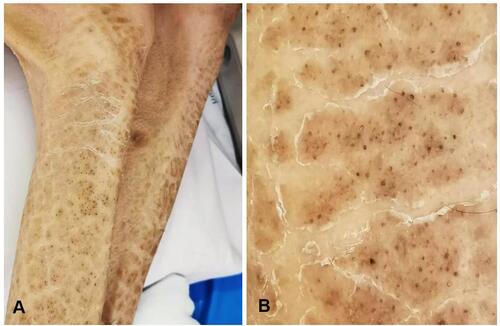 Figure 1 Dermatological examination: (A) multiple brown scales with adherent centers and detached, outward-turning edges, with multiple, overlying, small black dots on the extensor areas of both lower extremities; (B) close-up view showing abnormal hairs on the areas of skin abnormality.