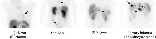 Figure 4.  Grading scale (1–4) for determining tumour uptake on [111In-DTPA0]octreotide scintigraphy on planar imaging. Tumour uptake should be grade 2 or more for therapy with [177Lu-DOTA0,Tyr3]octreotate.