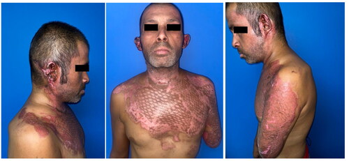 Figure 4. Three months after hospital discharge, the appearance of the patient showed all grafts satisfactorily integrated.