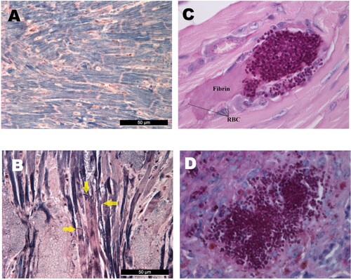 Figure 4. Histological findings from neutropenic mice intravenously challenged with Candida auris. Normal (A) and damaged heart (B) with Mallory’s PTAH staining. PTAH staining performed on the heart of a moribund dissected mouse on day 5 infected with isolate 196 (B) revealed contraction band necrosis or myofibrillar degeneration (yellow arrows). Morphology of C. auris with Periodic Acid Schiff (PAS) staining in the heart’s arterioles on day 1 post infection (C), and in the spleen (D). PAS staining showed blastoconidia and budding yeast cells but never pseudohyphae and hyphae (C–D). Magnification, A-B × 400, C × 1000, D × 400, RBC; red blood cells.