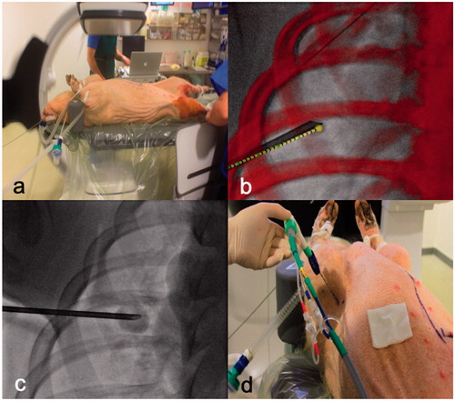Figure 1. Experiment setting and workflow. (a) This figure shows the installation of the pig under general anesthesia. Tumor mimic lesion injection to create 1, 2 or 3 cm tumor with (b) or without (c) guidance software. Ablation probe was inserted through the same coaxial canula (d) facilitating the accurate targeting of the tumors.