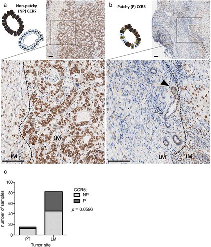 Figure 2. CCR5 expression patchiness in liver metastases of colorectal cancer. Representative micro-images and schematic representation of a patchy (a) and a non-patchy (b) CCR5 expression pattern in a liver metastasis. Black arrowheads indicate cancer cells positive for CCR5, empty arrowheads indicate negative cancer cells. Scale bar: 100 µm. (c) Contingency of tumors expressing CCR5 in a patchy or non-patchy fashion in stage IV primary tumors (PT, n = 15) or liver metastases (LM, n = 82), analyzed with a one-tailed Fisher’s exact test.