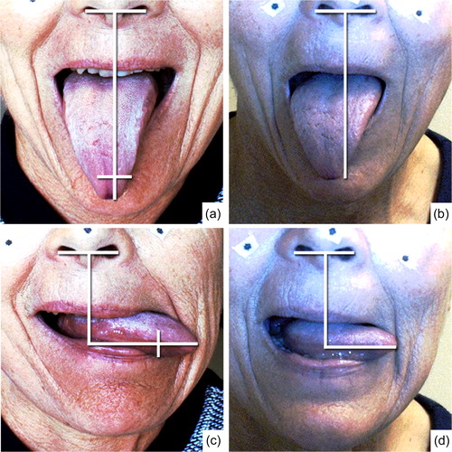 Figure 11. Left: preoperative video stills from down and leftward protrusion of the tongue. The horizontal white line represents the magnitude of motion of the tongue in a certain direction seen from the nostrils. An extra vertical line on top of the horizontal line projects the post-operative magnitude of motion on the preoperative video stills. Right: Post-operative video stills. The video stills are printed with written permission of the patient.