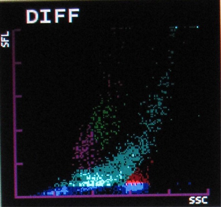 Figure 7. Rightward shift of RBC ghost area in DIFF scattergram.