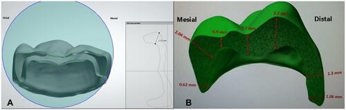 Figure 2 Thickness of experimental crown of (A) group A at mesio occlusal point; (B) group B at different areas.