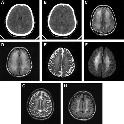 Figure 1 Images of delayed postanoxic encephalopathy.