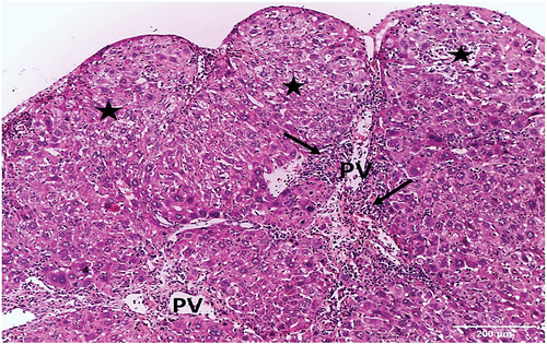 Figure 4. Photomicrograph of a liver section of HCC control group showing several nodules (asterisks) with indefinable radiated cell plates, and portal veins (PV) surrounded by inflammatory infiltrates (arrows) (HX&E X100).