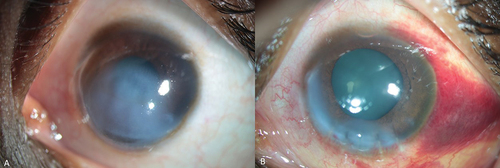 Figure 8. (a, b): a: Preoperative slit-lamp photograph of the Patient 7; b: Postoperative picture after 1 h of the surgical intervention showing marked clearing in the central cornea.