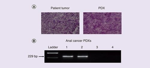 Figure 3. Histological characterization and HPV16 status of anal cancer patient-derived xenografts. (A) H&E-stained sections of matched patient tumor and PDX of an anal cancer revealed similar histological features. (B) PCR was used to detect the HPV16 genome in one out of three anal cancer PDXs.H&E: Hemotoxylin and eosin; Lane 1: HPV16+ SiHA cervical carcinoma cells (positive control); Lanes 2–4: Anal cancer PDXs; PDX: Patient-derived xenograft.