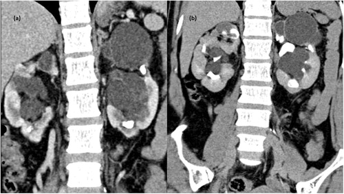 Figure 2. CT scan venous phase in coronal plane showing nonenhancing collection in peripelvic region of both kidneys (d) MPR reformation of coronal plane of delayed phase of CT scan abdomen showing normal excretion of contrast with no evidence of leakage in PC system. Bilateral peripelvic lymphangiectasia. Associated cystic lesions are also seen.