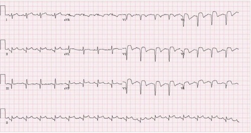 Figure 1 Electrocardiography on admission.Note: Electrocardiography showed pathologic Q wave with elevated ST segments in whole precordial and inferior leads.
