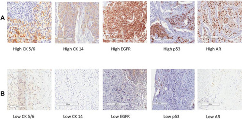 Figure 1 Triple-negative breast cancer. (A) Representative images of immunohistochemical staining of high CK 5/6, CK 14, EGFR, p53 and AR. (B) Representative images of immunohistochemical staining of low CK 5/6, CK 14, EGFR, p53 and AR. Original magnification: ×400 (×40 objective).