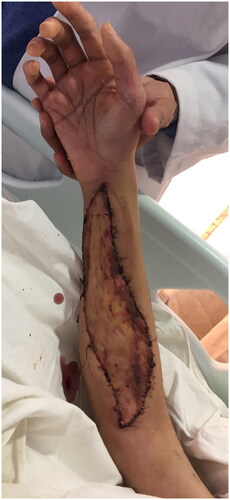 Figure 6. Clinical Photo of patient’s right forearm after skin grafting.