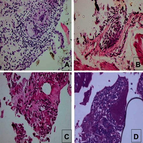 Figure 1 Histopathological examples of those with proved diagnosis in forceps transbronchial lung biopsy group.