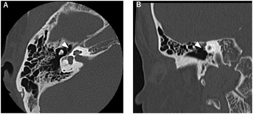 Figure 2. Images of right temporal bone computed tomography. Dehiscence of the tympanic segment of the facial nerve canal is visualized (arrow head). (A) and (B) show axial and coronal view, respectively.