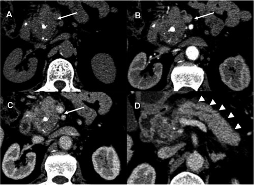 Figure 2 A 54-year-old man with mass-forming autoimmune pancreatitis. (A) Unenhanced image demonstrates an isoattenuation mass (arrow) located in the head of the pancreas and calcifications were clearly seen within the tumor. Arterial (B) and portal venous (C) phase images show an ill-defined mass (arrows) with progressive enhancement. (D) Axial CT images at the portal venous phase show diffuse enlargement of the pancreatic parenchyma (arrowheads) with slight main pancreatic duct lumen dilatation.Abbreviation: CT, computed tomography.