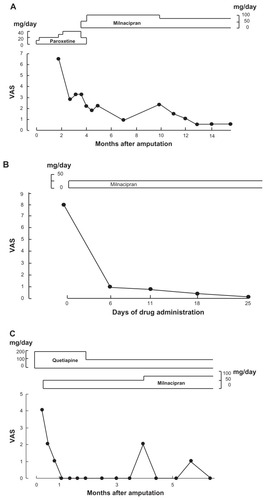 Figure 1 Change in phantom limb pain during therapy. (A) Case 1 shows initial use of paroxetine which was partially effective but required high doses. Stepwise switch to milnacipran continued to improve pain relief, leading to a long-term near-total absence of pain. (B) Case 2 shows a dramatic reduction in pain within 6 days of introduction of milnacipran. Total pain relief was obtained after less than 4 weeks of therapy. (C) Case 3 shows that administration of quetiapine to control delirium had no effect on pain relief produced by milnacipran, which was complete within a month. Subsequent resurgences of pain were controlled by increasing the dose of milnacipran.
