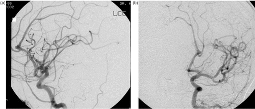 Figure 1. A digital subtraction angiogram of the left common carotid artery demonstrates an aneurysm at the bifurcation of the left A2 artery. (a) Lateral view. (b) Oblique view.