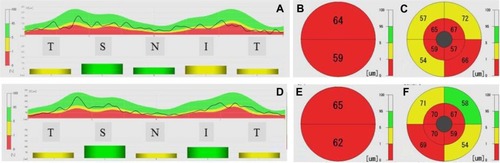 Figure 4 Right (A–C) and left (D–F) optical coherence tomography scans showing decreased retinal thickness.