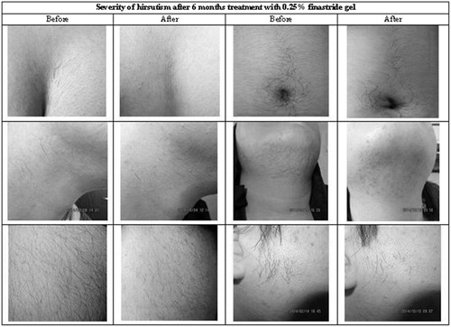 Figure 1. Severity of hirsutism after 6 months treatment with 0.25% finastride gel.