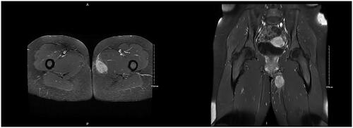 Figure 3. MRI demonstrating soft tissue mass measuring 4.8 x 2.7 x 4.0 cm extending into the left gracilis muscle.